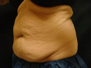Before: CoolSculpting abdomen